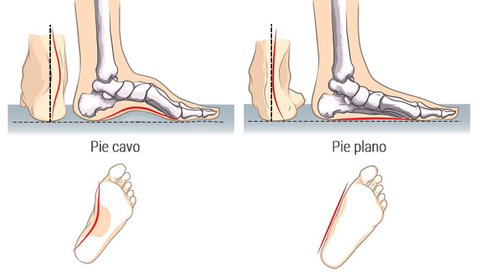 pies-planos-cavos